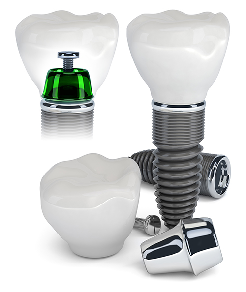 Dental Implants 01906