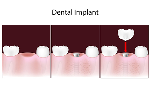 Saugus Dental Implants