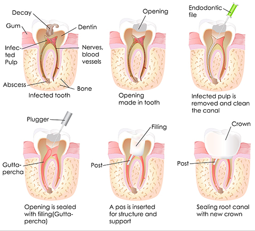 Saugus Root Canals